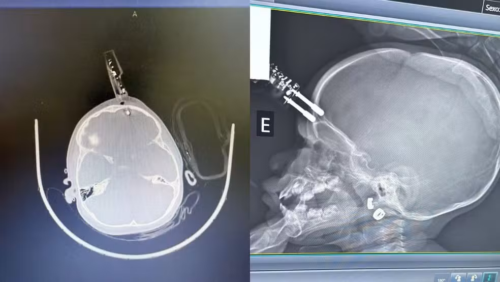 Menina de 1 ano passa por cirurgia após carregador de celular se cravar em sua testa em queda da cama