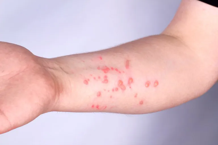 Minas confirma três casos de mpox em 2026 e acende alerta para prevenção